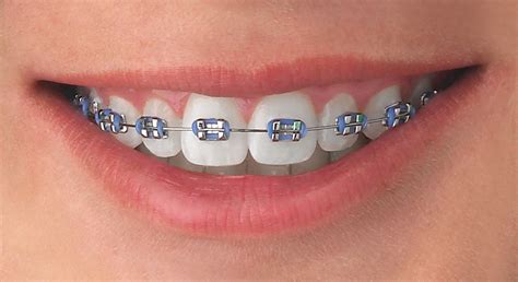 moda de brackets de colores